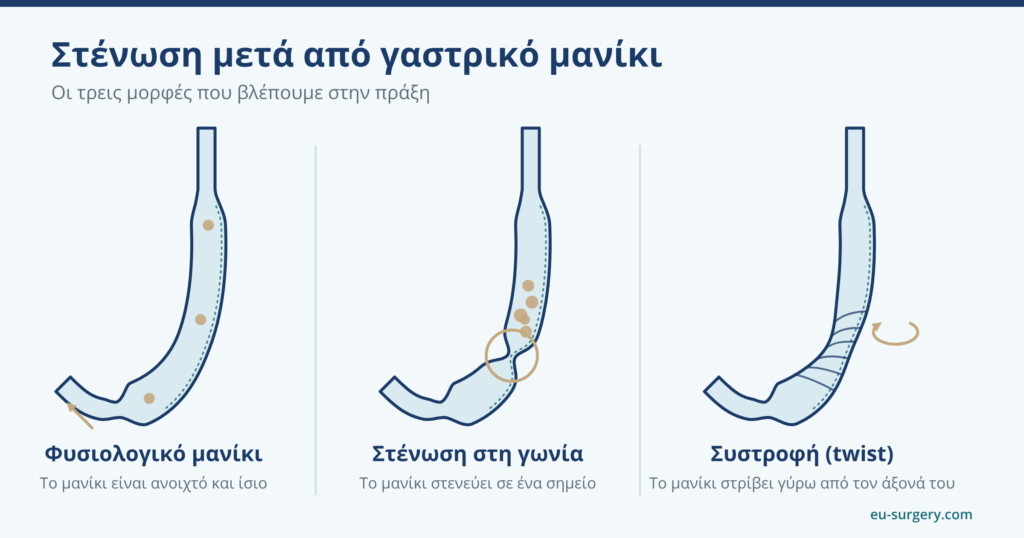 Σχεδιάγραμμα φυσιολογικού γαστρικού μανικιού, στένωσης στη γωνία του στομάχου και συστροφής του μανικιού