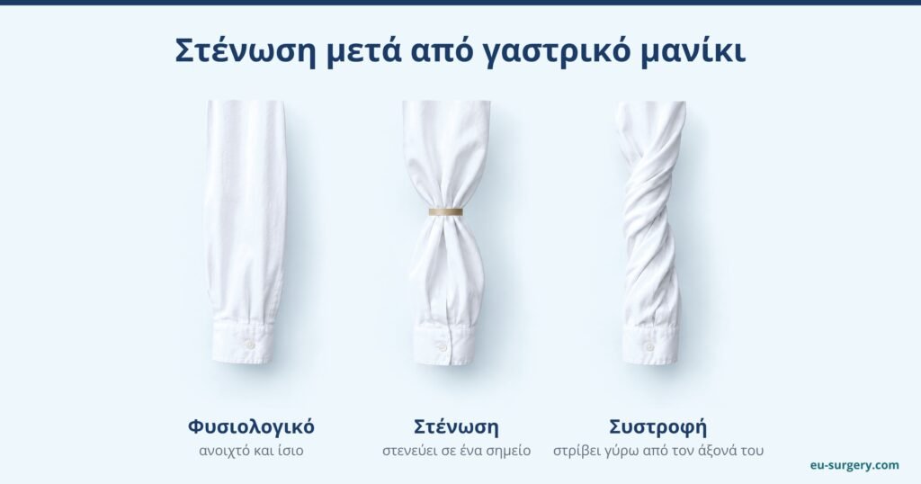 Τρία μανίκια πουκαμίσου, φυσιολογικό, σφιγμένο σε ένα σημείο και στριμμένο, ως αναλογία για τη στένωση και τη συστροφή μετά από γαστρικό μανίκι